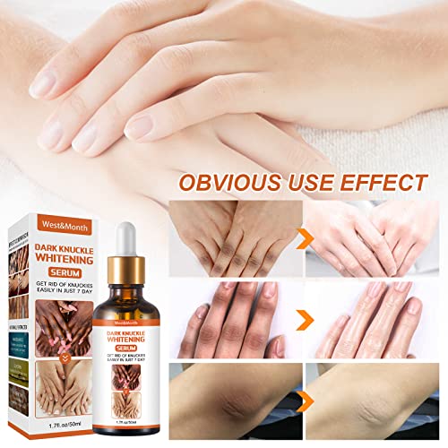 Dark Knuckle Whitening Serum 50ml - For Knuckles, Elbows, Knees & Dark Spots
